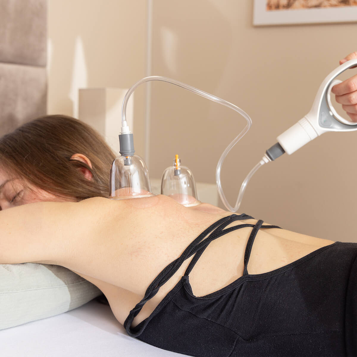 Schröpftherapie mit Handpumpe: zwei transparente Schröpfgläser am Rücken einer Person, Vakuumpumpe über Schläuche verbunden, therapeutische Umgebung

