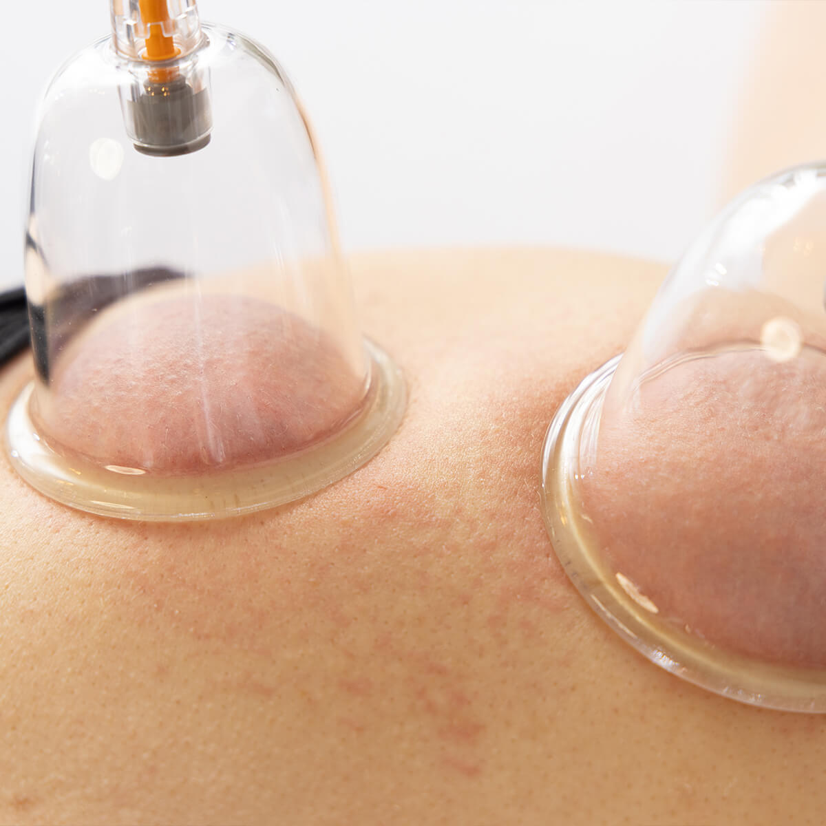 Nahaufnahme von zwei transparenten Schröpfgläsern auf geröteter Haut während Schröpftherapie, zeigt Vakuum-Saugwirkung der Behandlung
